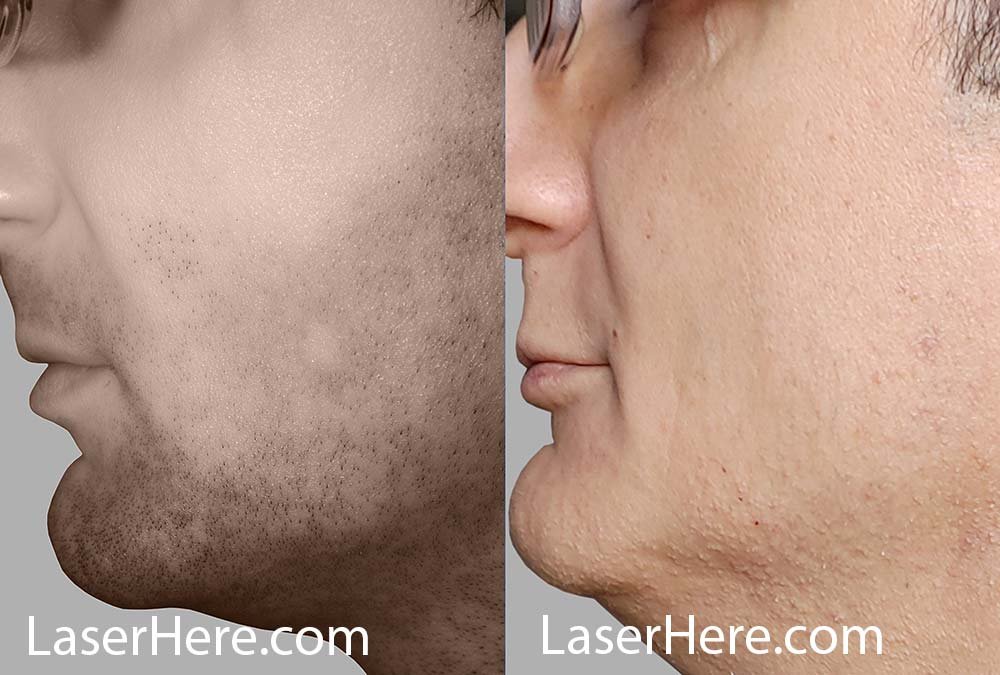 Gary-Face-Before-After